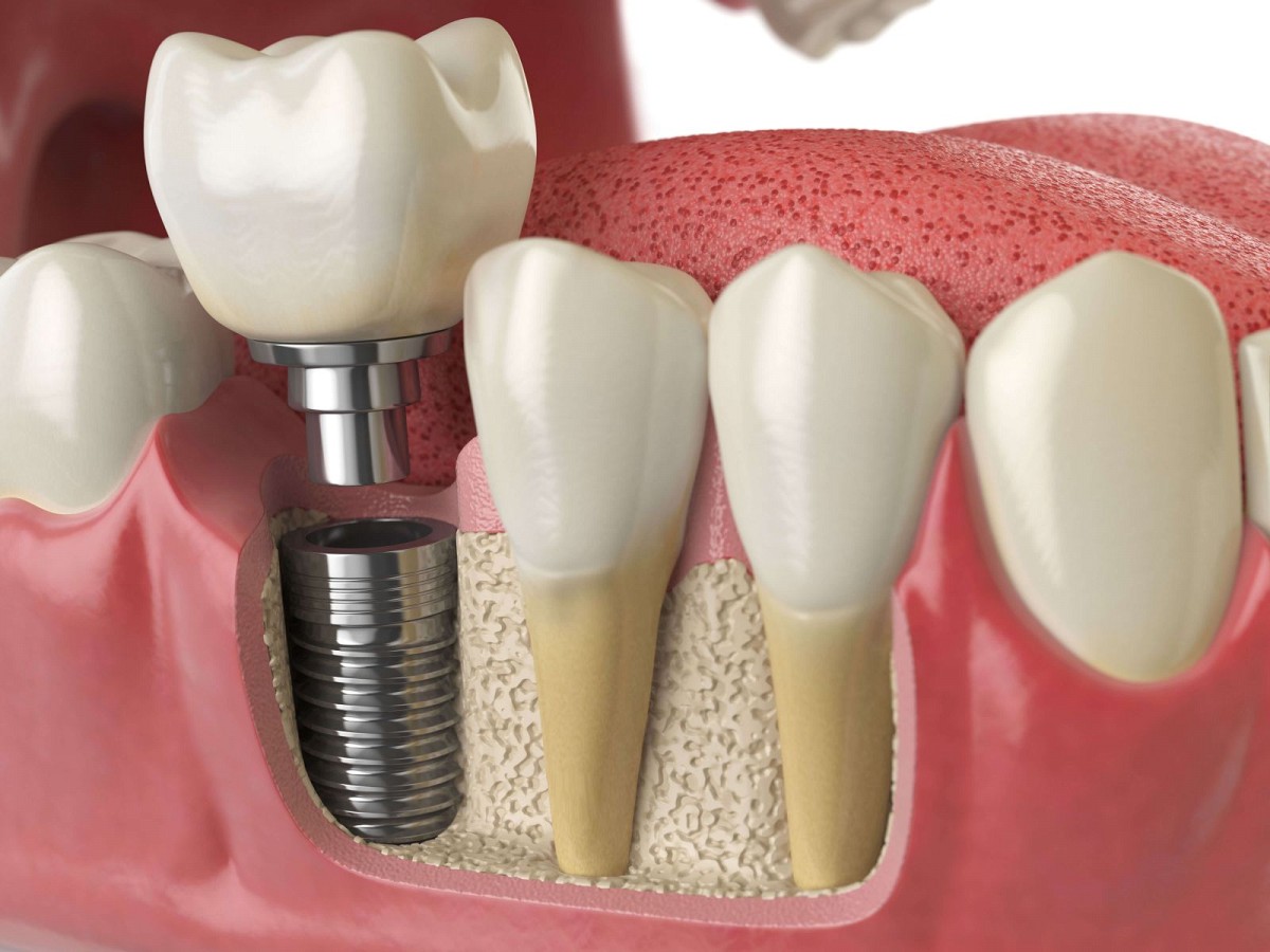 Vstavitev implantata