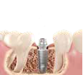 Implantat